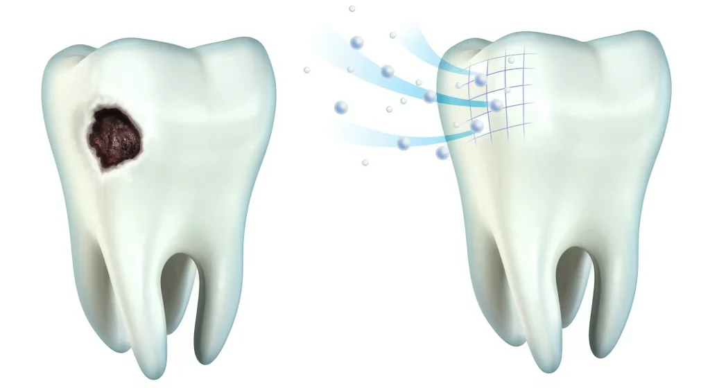 Кариес и пломба