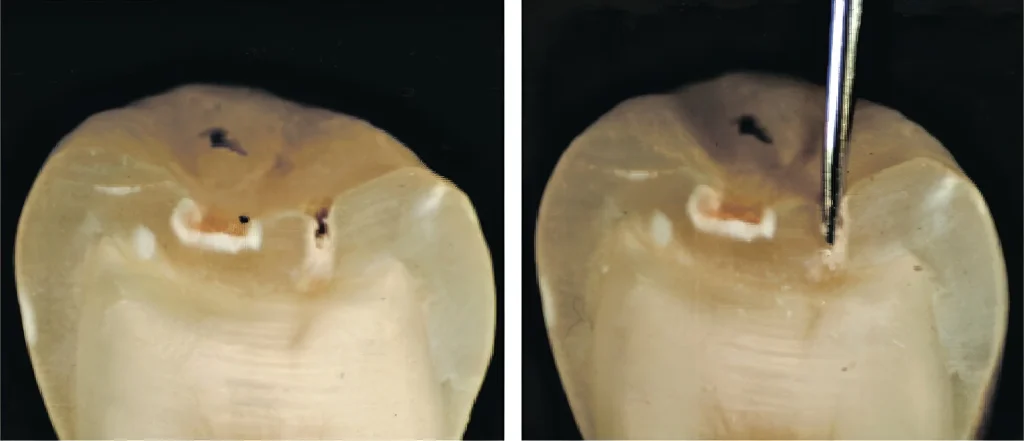 Как микроскоп помогает в диагностике скрытого кариеса