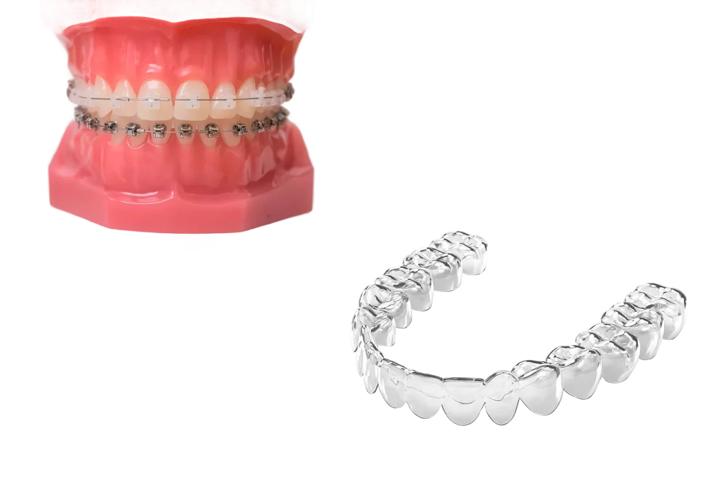 Брекеты или элайнеры