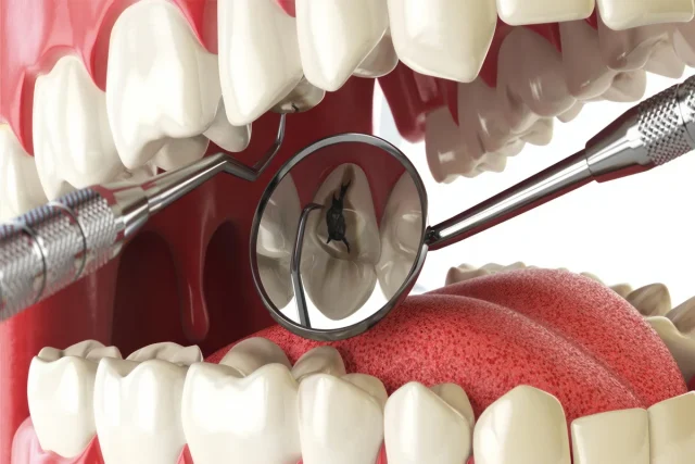 Можно ли сохранить зуб при глубоком кариесе? Мой честный ответ: чаще всего — да