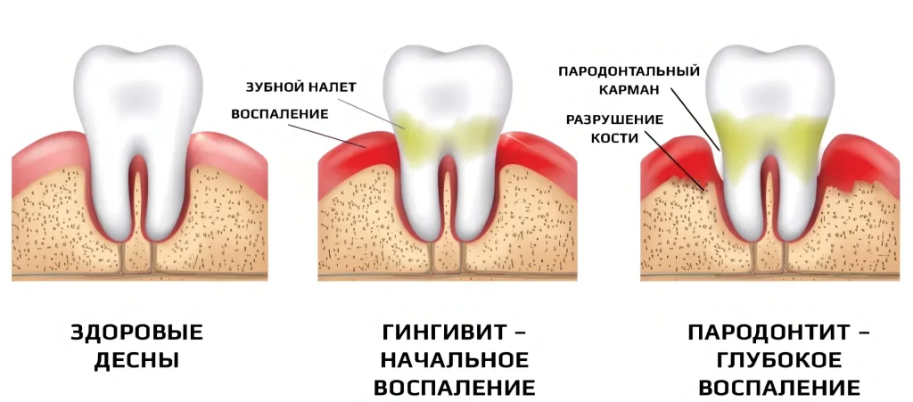 Воспаление десен (гингивит и пародонтит)