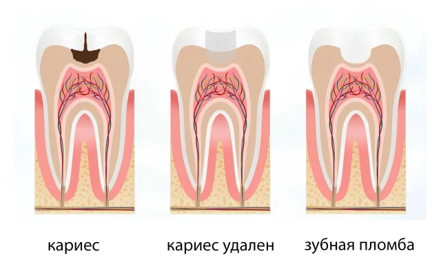Как избежать ошибок при первичном лечении каналов