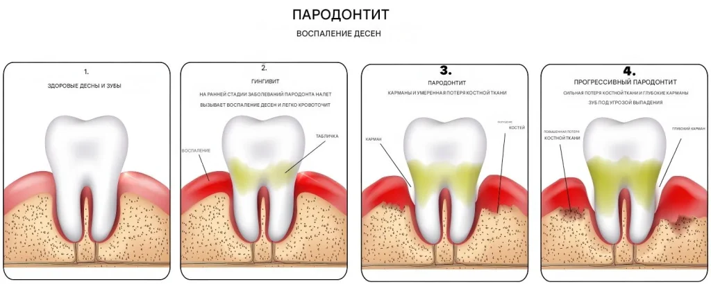 Периодонтит