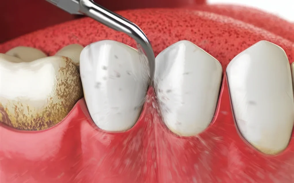 Чистка зубов ультразвуком