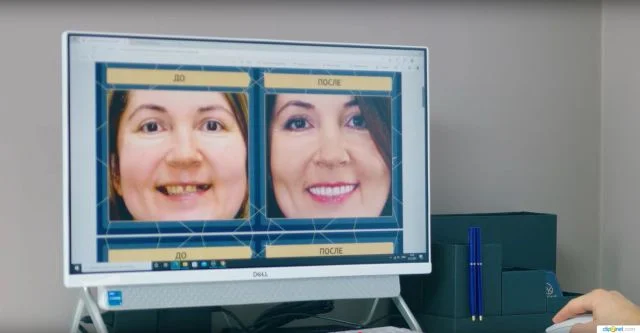 Восстановление зубов