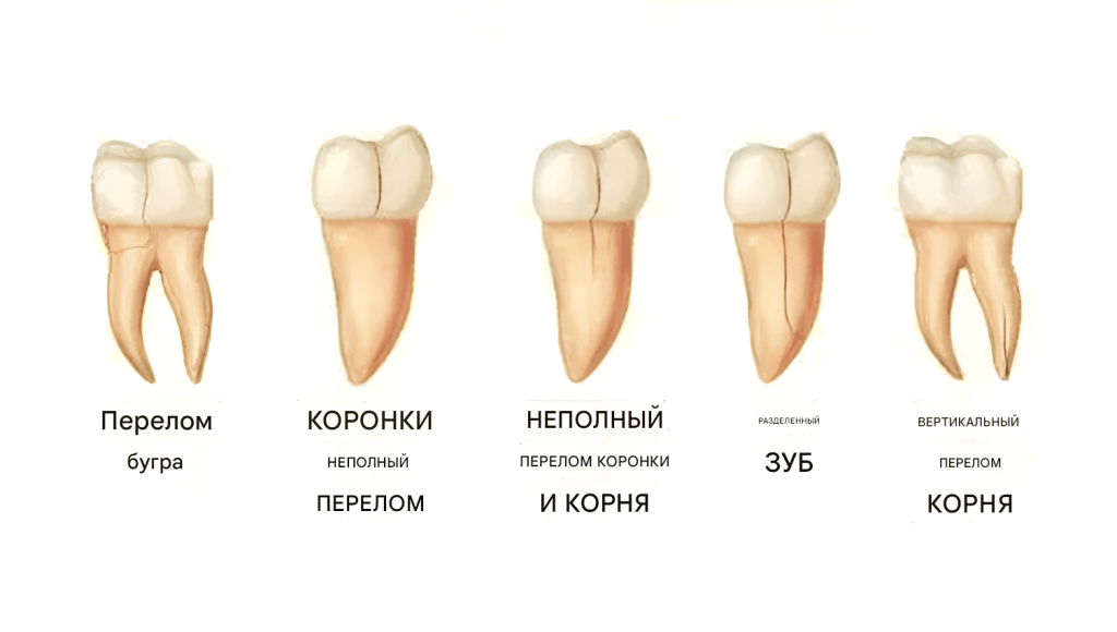 Клинические формы трещин зубов