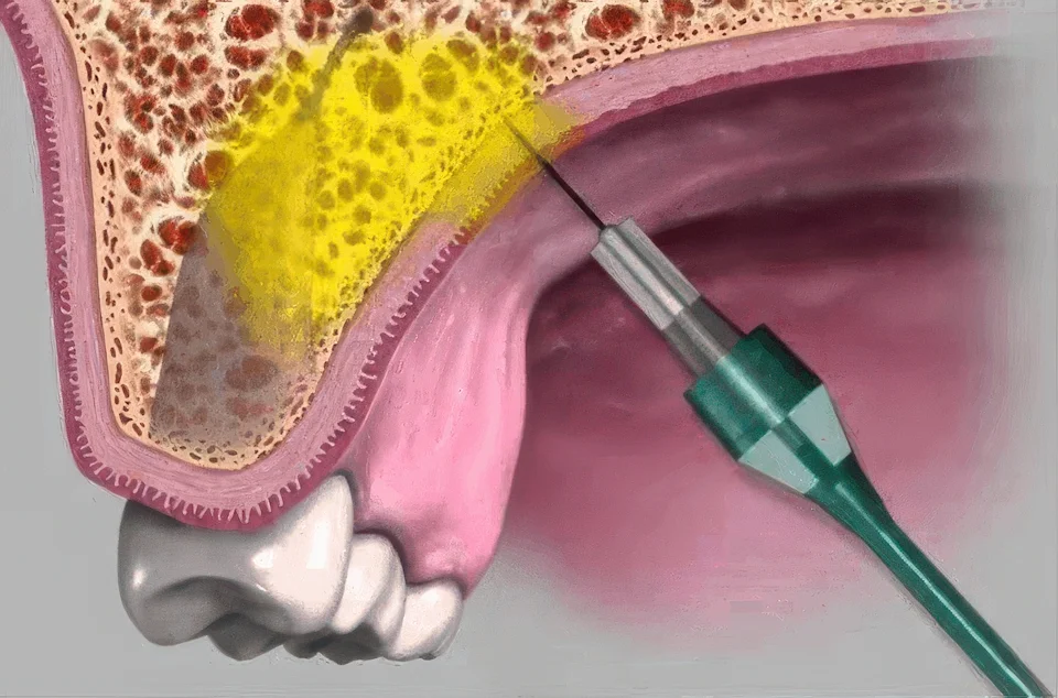 Анестезия инфильтрационная