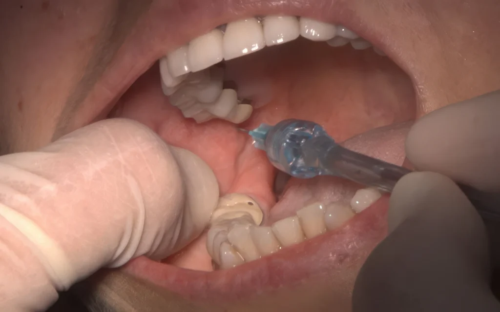 Обезболивание при лечении зубов: как я делаю приём спокойным и предсказуемым